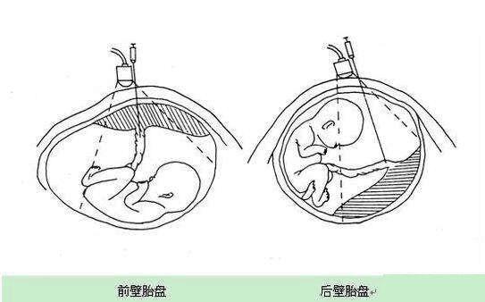 胎盘前壁和胎盘前置有什么区别？注意后者很危险