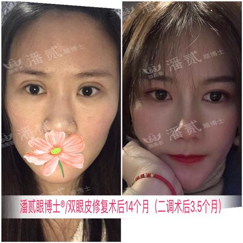 广州双眼皮修复哪家医院好？