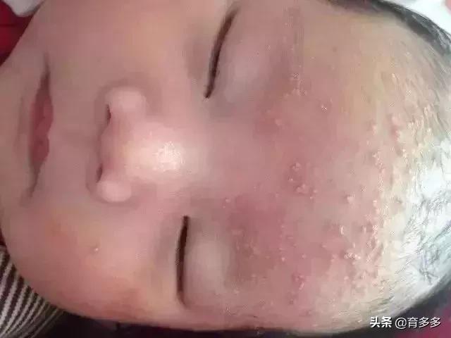 宝宝夏天出汗多怎么护理