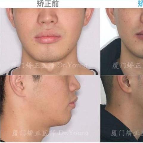 厦门市拔牙多少钱