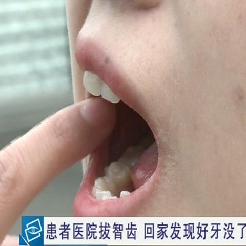 武汉大众口腔拔智齿便宜不？