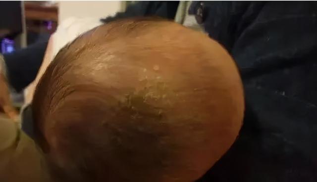 新生儿头皮上的乳痂怎么去除