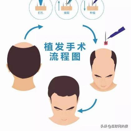 合肥哪家医院植发就技术好？