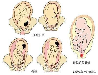 胎儿臀位脐带绕颈一周怎么办34周