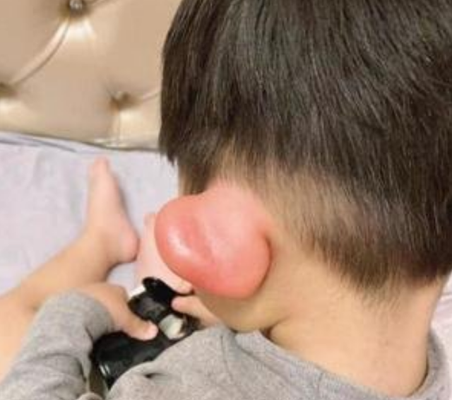 宝宝被蚊子咬了怎么护理