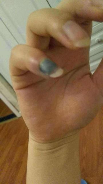 宝宝手指不小心被夹伤了