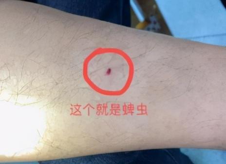 被蚊子叮后为什么长红包