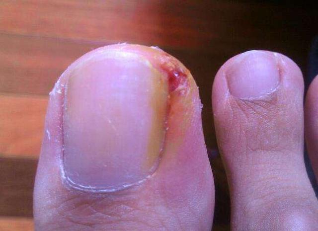 甲沟炎是怎样造成的 甲沟炎是怎样造成的