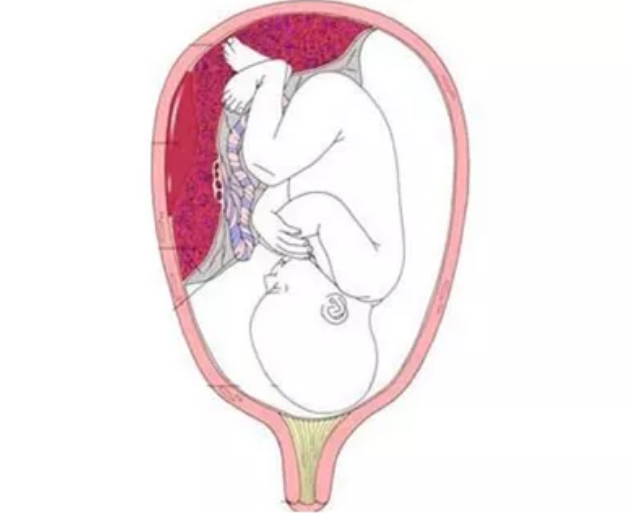 胎盘位于子宫前壁正常吗？