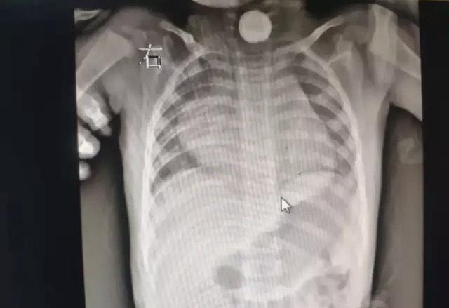 孩子容易误吞异物怎么办