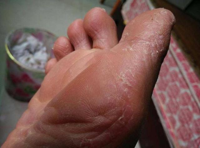 如何预防孩子手脚脱皮
