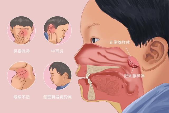 儿童感染腺病毒有哪些症状