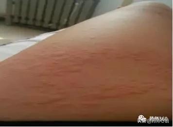 急性荨麻疹和慢性荨麻疹有什么区别