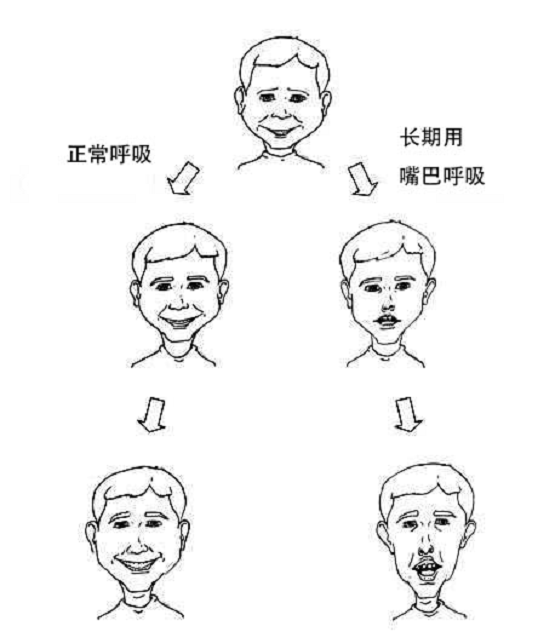宝宝用嘴呼吸怎么纠正