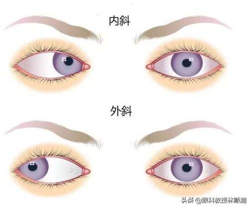 孩子有哪些症状是近视的预兆