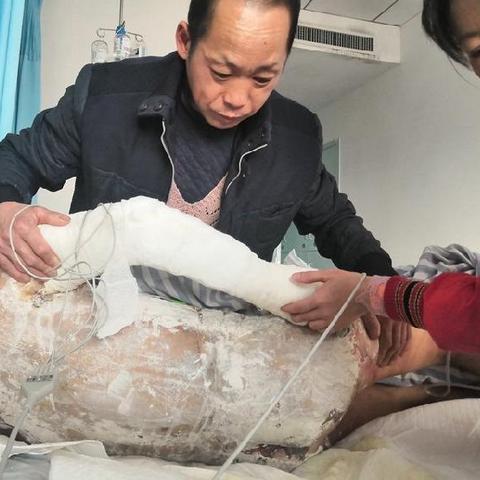 武汉市看烫伤哪个医院