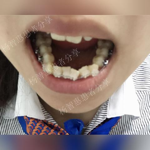 厦门哪里整牙的相关长尾关键词有哪些