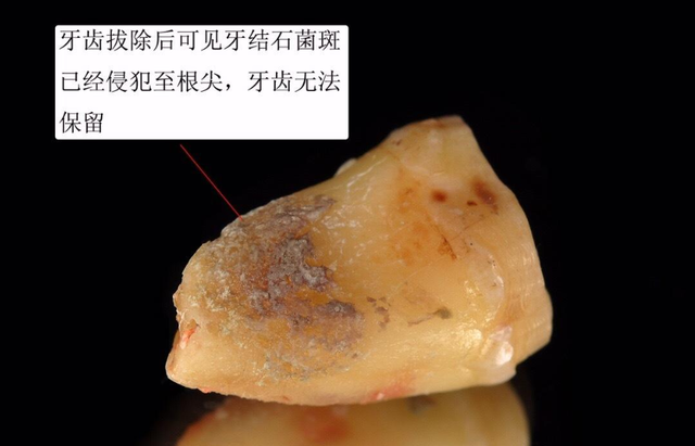 牙齿敏感是什么原因引起的