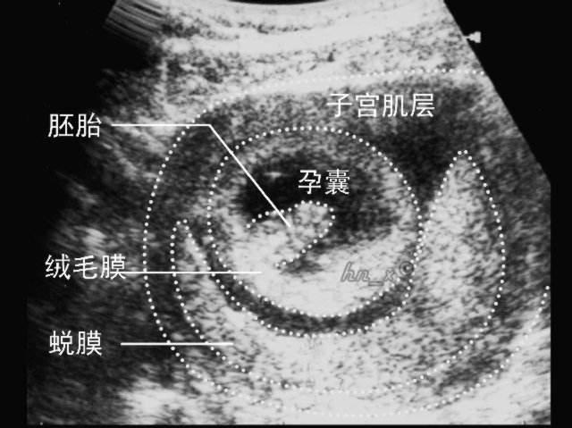 妊娠囊内可见卵黄囊是什么意思