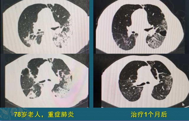 七岁男孩反复肺炎经检查多长了一个肺