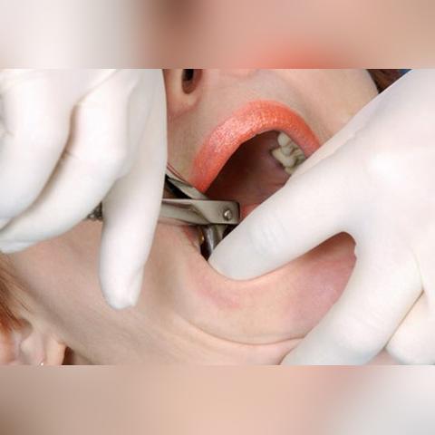 大连拔牙智齿的长尾关键词有什么