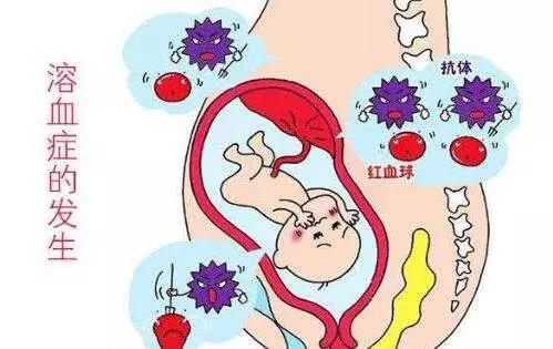 新生兒血溶症是什麼原因新生兒溶血癥的原因是什麼