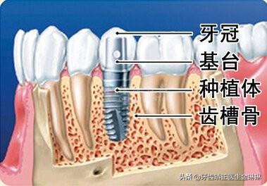 为什么种植牙费用这么高