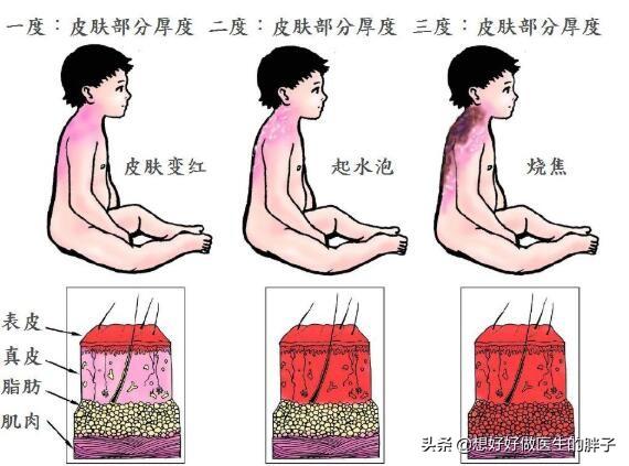 孩子被烫伤可以用牙膏吗