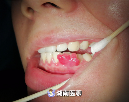 孕期牙龈出血