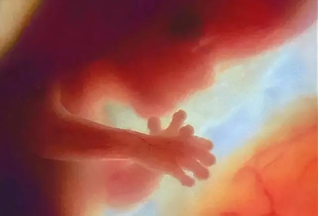 胎儿双肾集合系统分离是什么意思