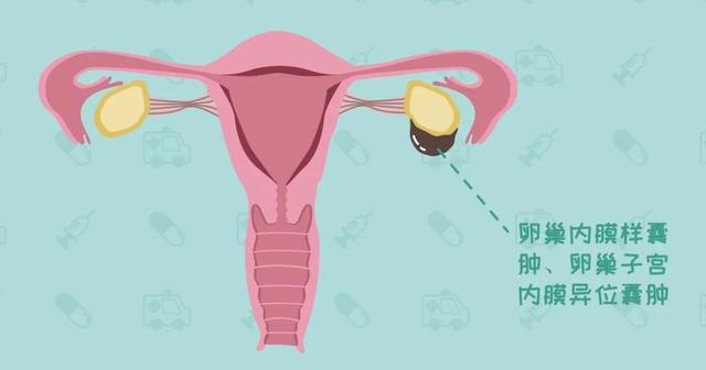女人必看！孕早期卵巢囊肿－－千万要小心
