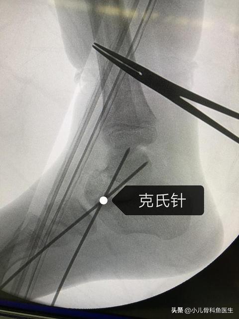 宝宝骨折了怎么办好