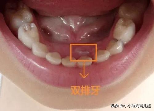 孩子乳牙碰松动了怎么办
