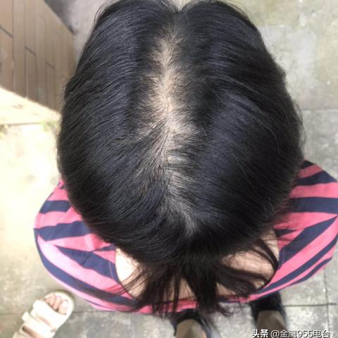 长沙治疗脱发医院好相关长尾关键词有哪些