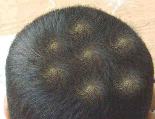 宝宝头顶有旋怎么起名(头旋和秃顶区别)