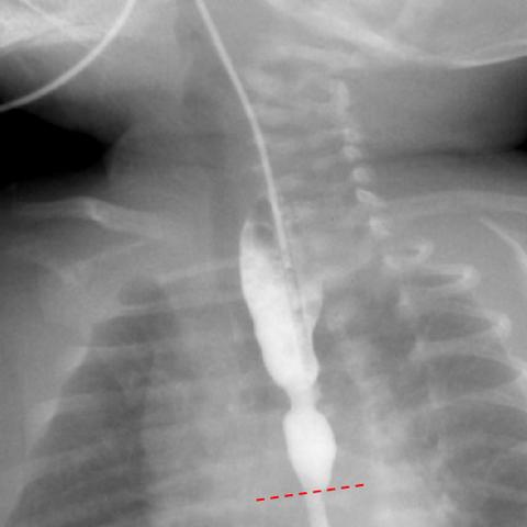 东莞市肾结石微创哪里好