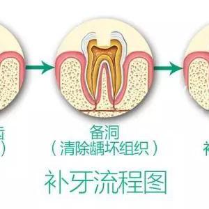大连医大二院 补牙的长尾关键词有什么