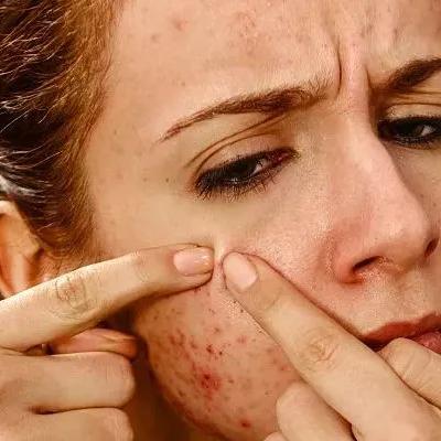 杭州市三院痤疮哪个专家