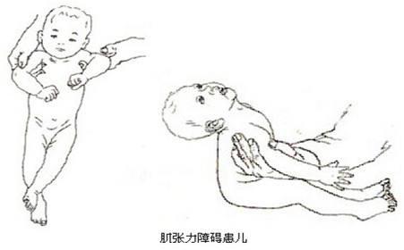 如何判断孩子肌张力高