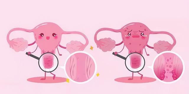 宫颈息肉会影响女性怀孕吗
