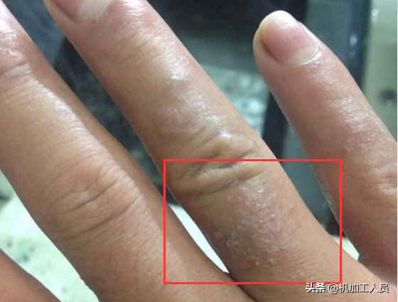 你见过最奇怪的过敏体质是什么
