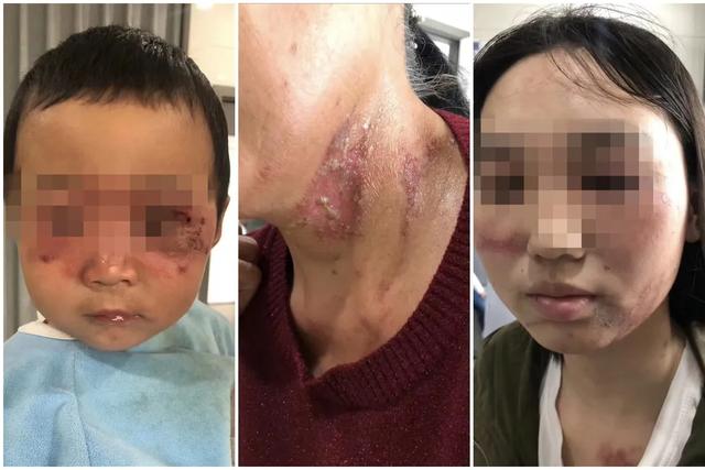 被隐翅虫叮了怎么办