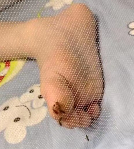 孩子总被蚊子咬是怎么办