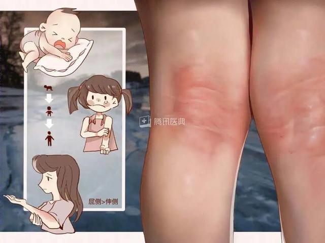 异位性皮肤炎和湿疹有什么区别 异位性皮肤炎和湿疹有什么区别