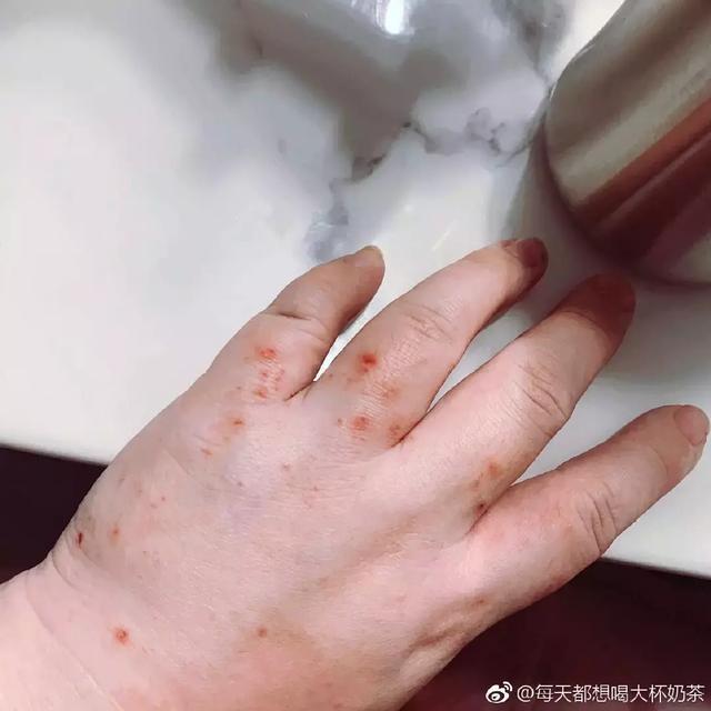 为什么怀孕会得荨麻疹