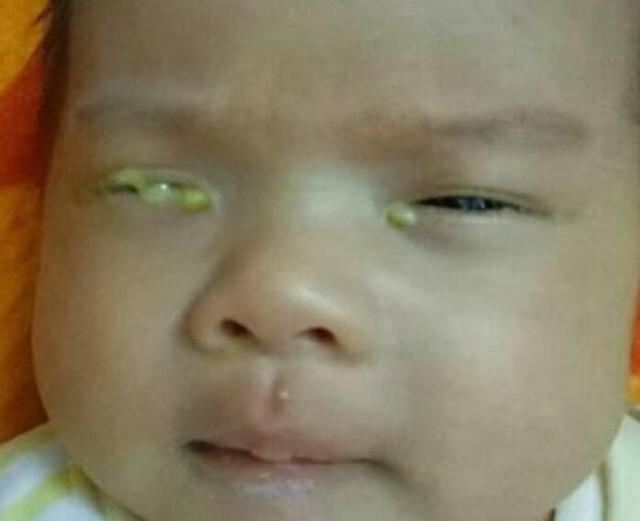 宝宝上火眼屎多又黄怎么办