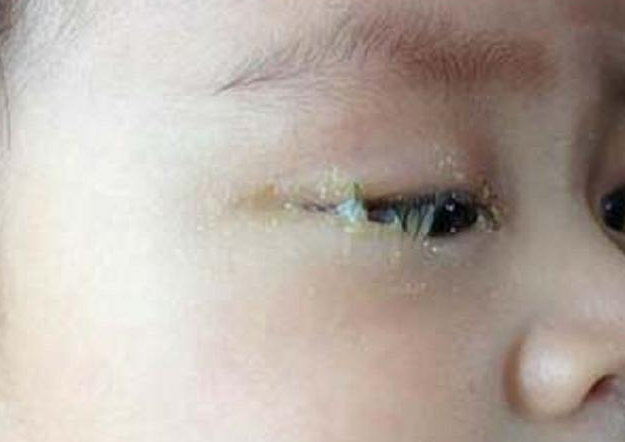 幼儿常见眼睛问题