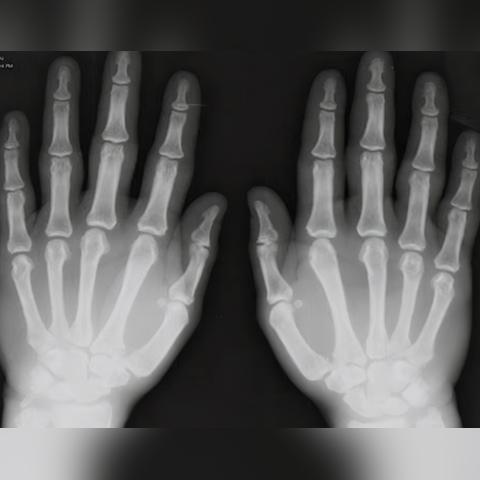 【甲胺,甲胺蝶呤片作用】 【甲胺,甲胺蝶呤片作用】