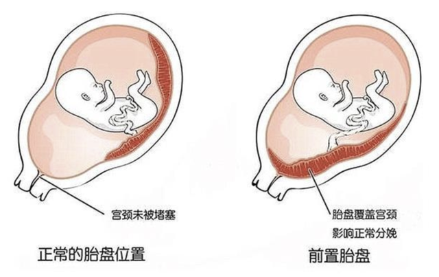 怀孕后显怀太早或者太晚是什么原因