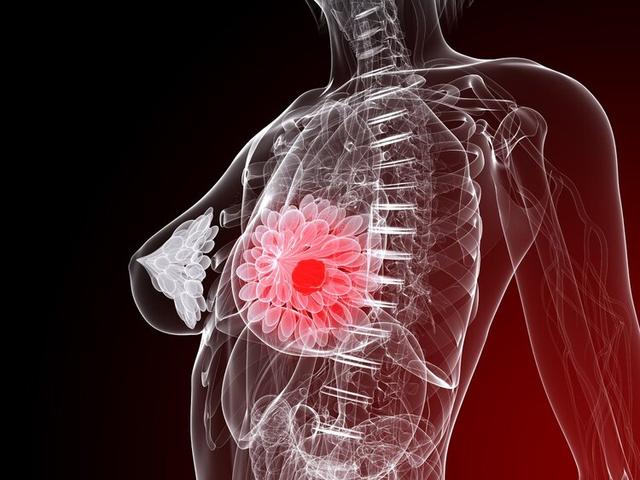 孕妇得乳腺癌什么症状